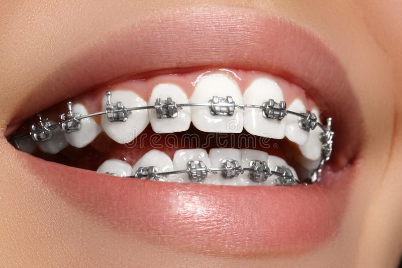 dental braces in islamabad