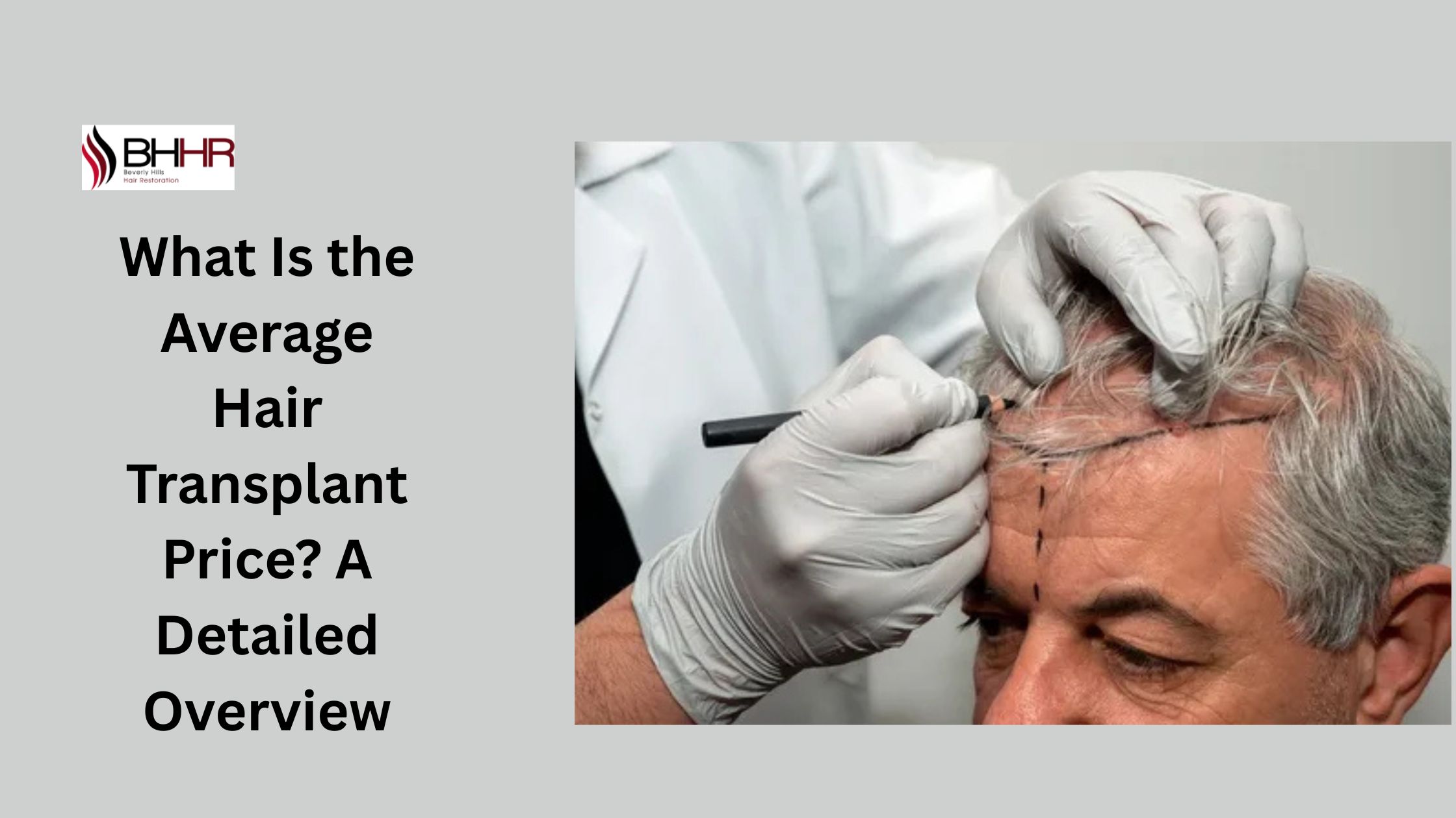 hair transplant price